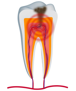 rootcanal